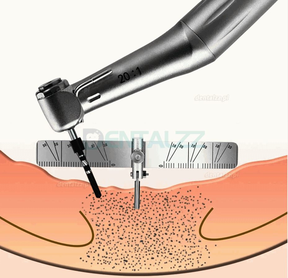 Lokalizator pozycjonowania implantów stomatologicznych Miernik linijki